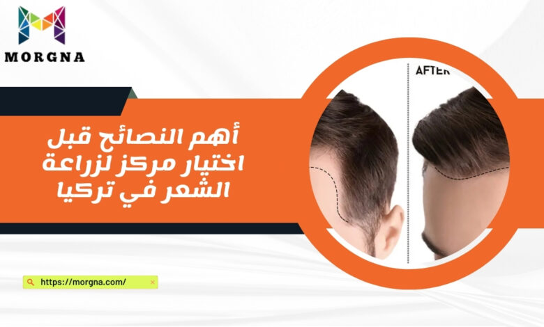 أهم النصائح قبل اختيار مركز لزراعة الشعر في تركيا